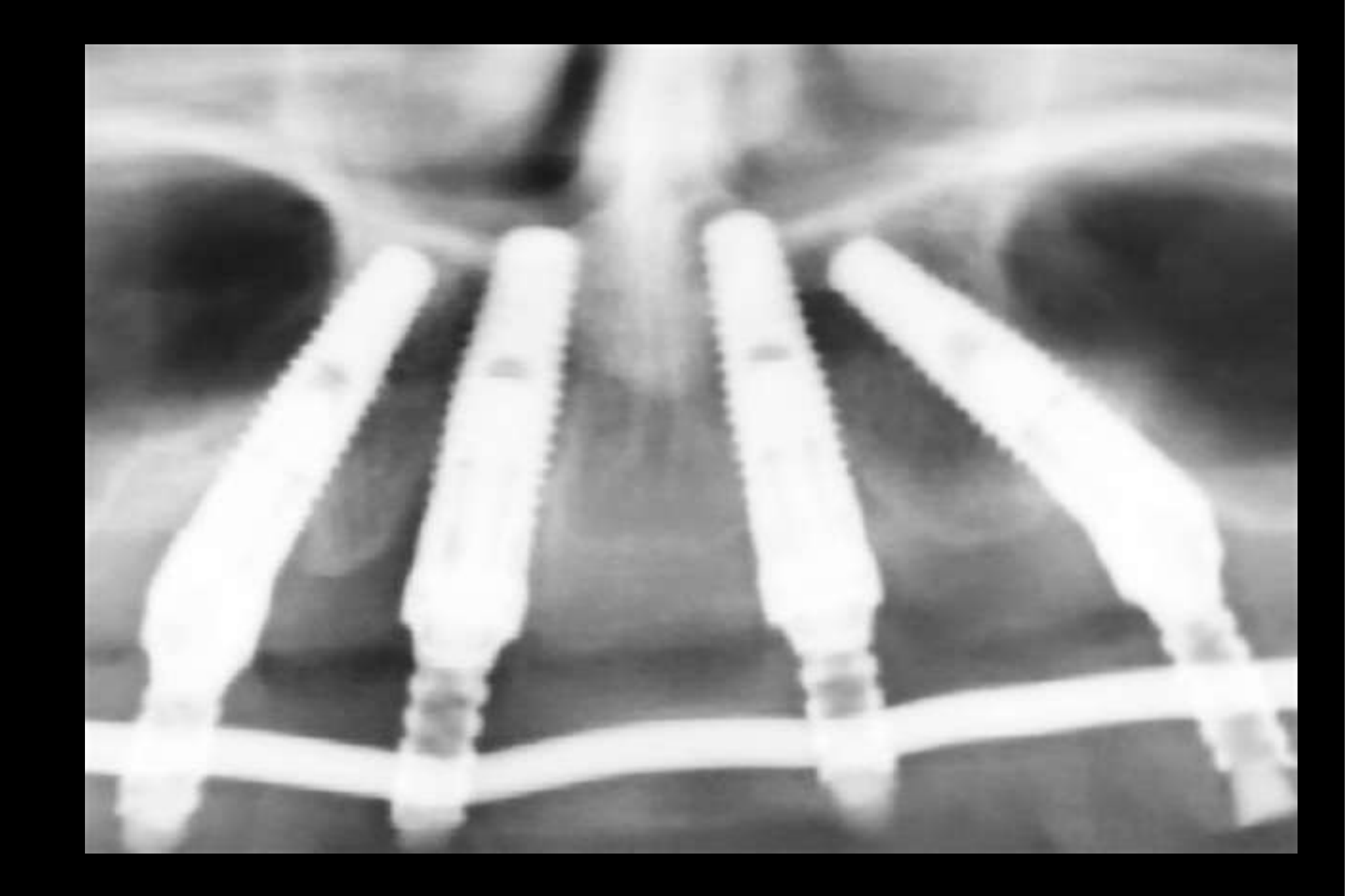 Chi-I-Kim and A. Kim; Implant failure; Seong-I-Kim. Star of death