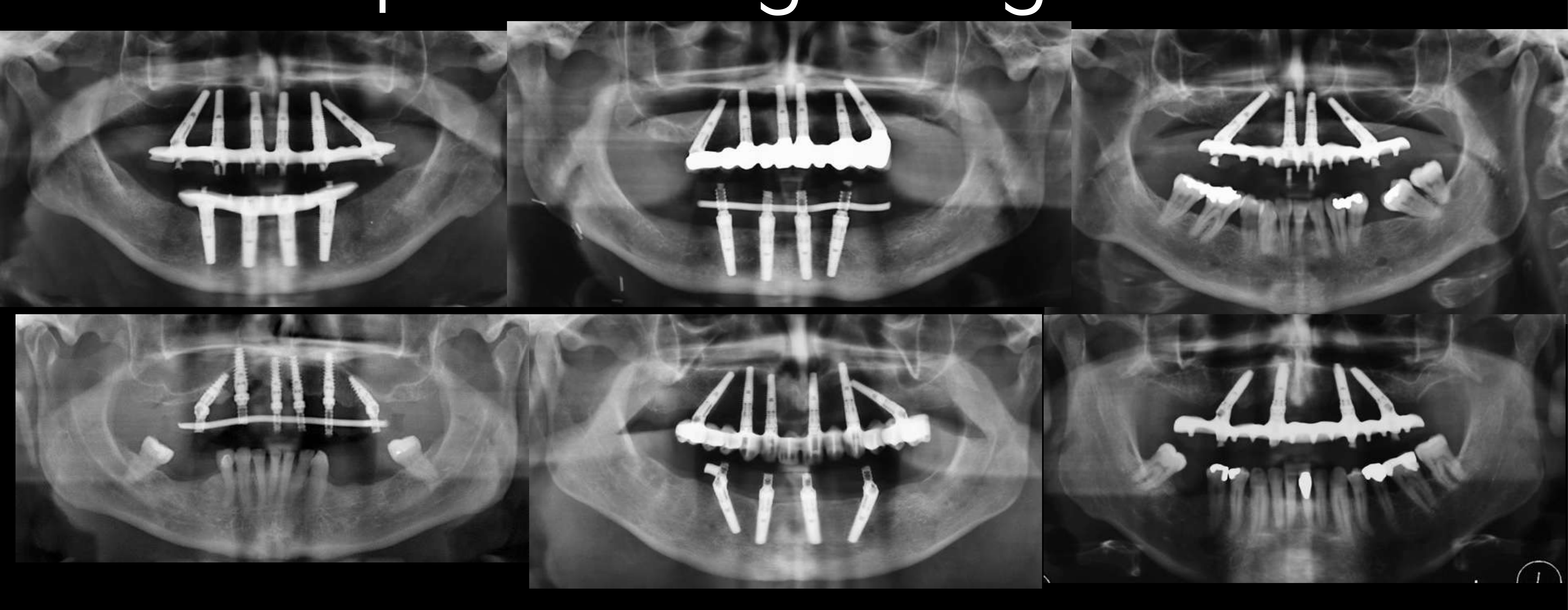 Tilted implants no grafting