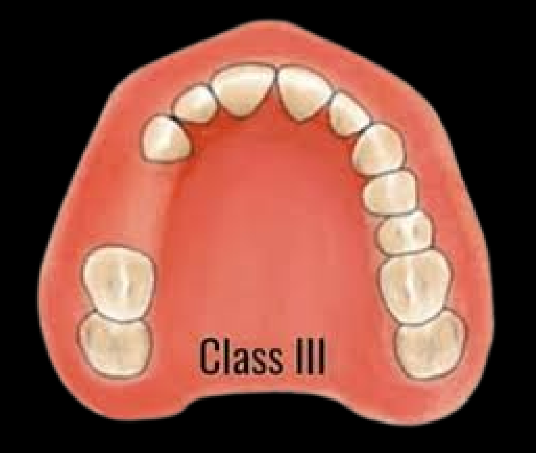 Class III