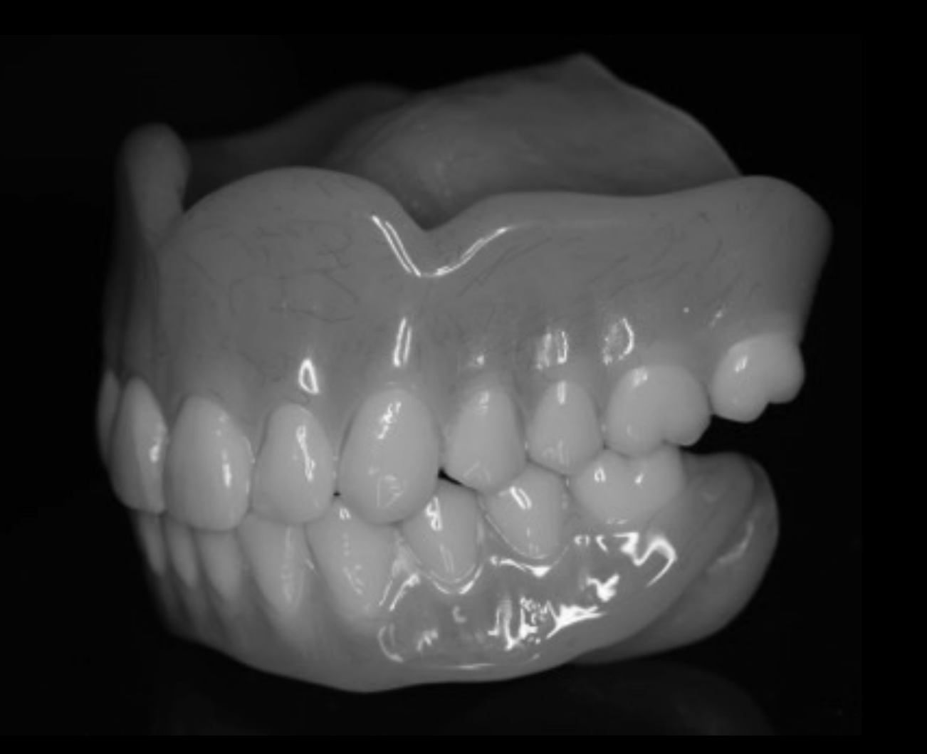 Complete Denture