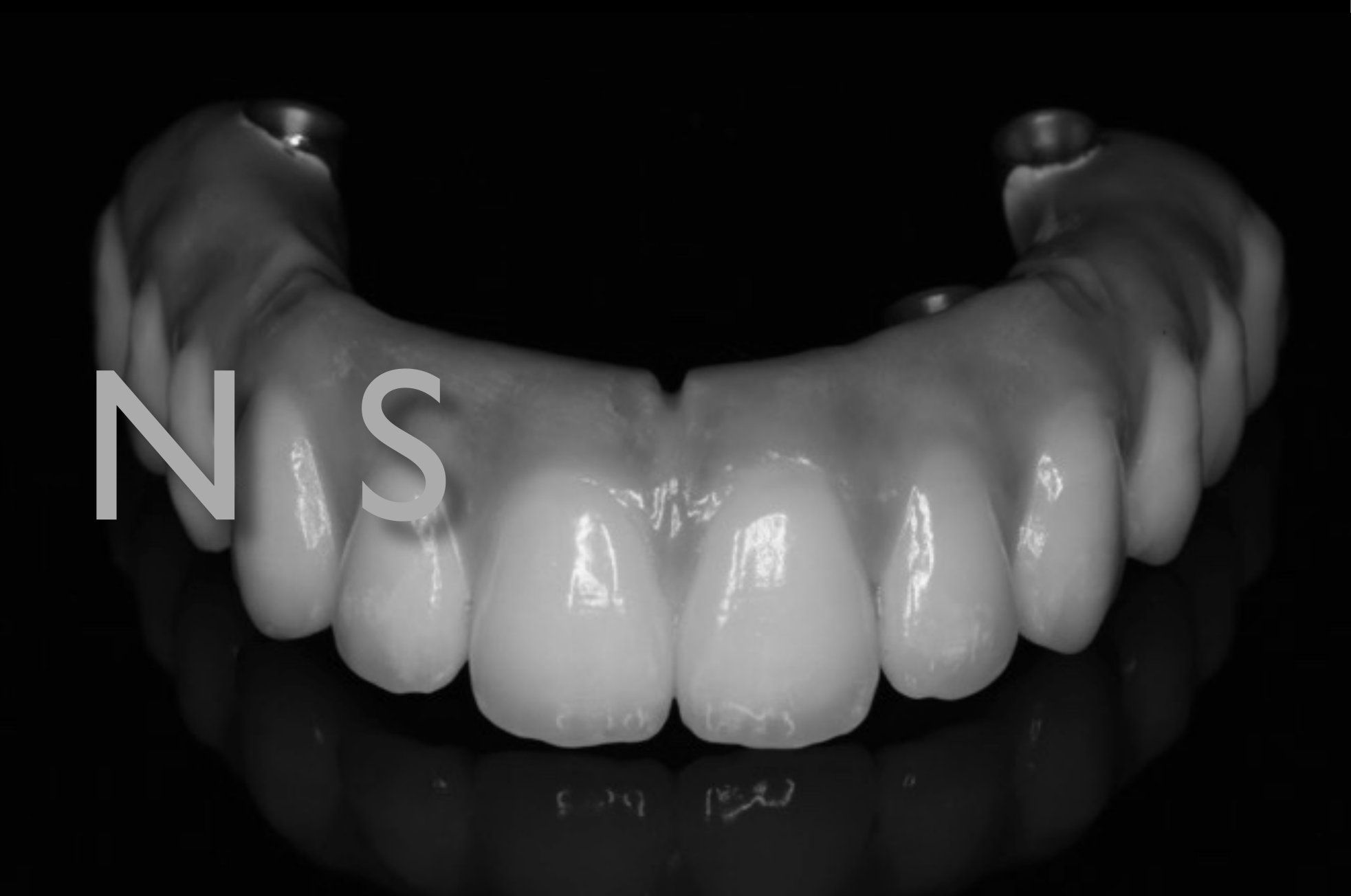 Need occlusal splint