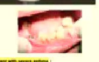 Swollen gums