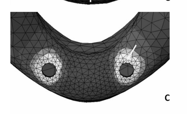 Two-implant design