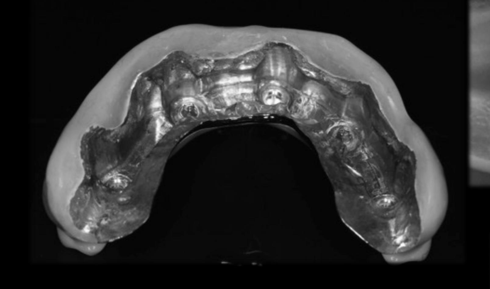 Implant Detachable Prosthesis