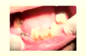 Figure 1.27.1- Picture of caries / retained roots in a patient with severe asthma