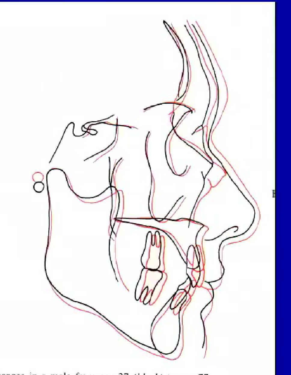 B, Growth changes in a woman between age 34 (black) and 83 (red)