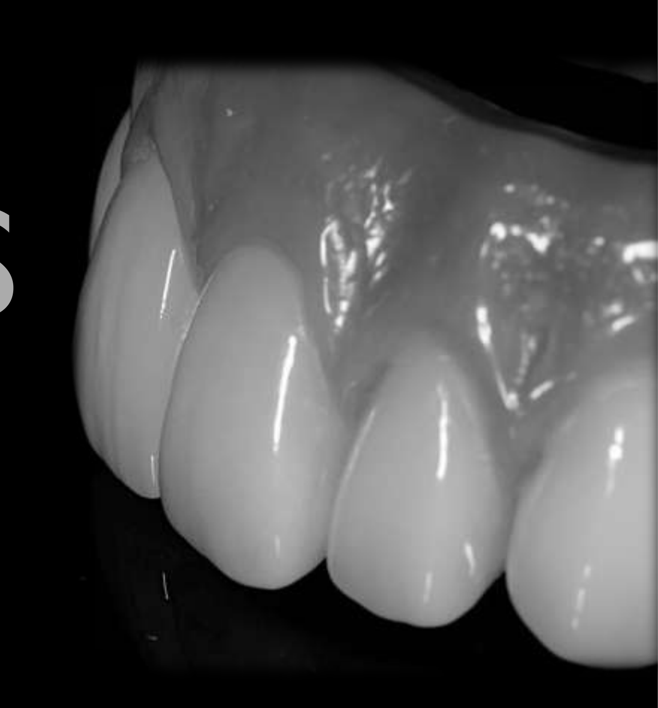 Need occlusal splint