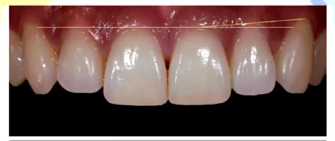 Gingival symmetry in relation to the centrals, laterals, and canines is essential to esthetics. Optimal esthetics is achieved when the gingival line is relatively horizontal and symmetrical on both sides of the midline, when considering the centrals and