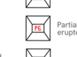 Partially erupted