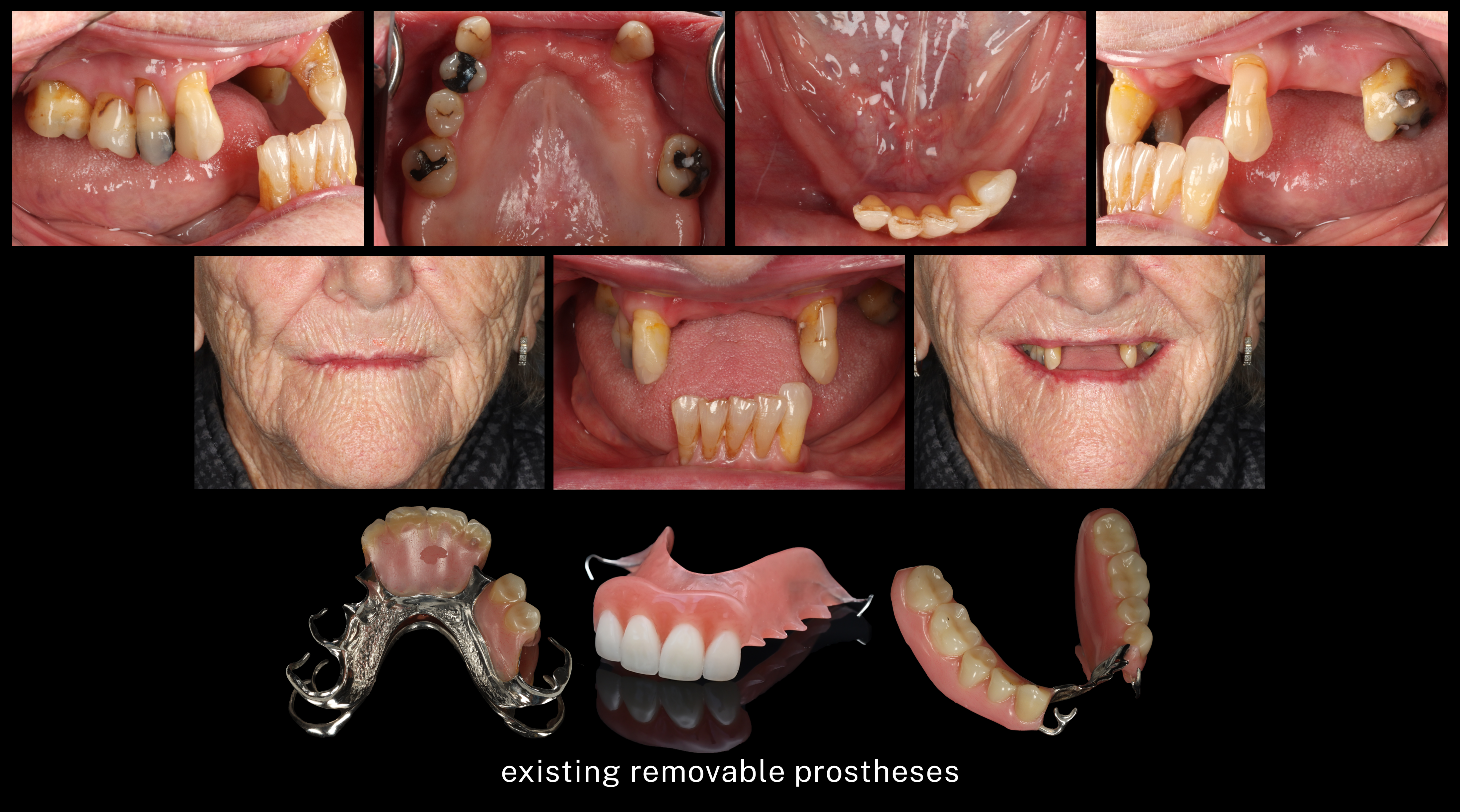 existing removable prostheses