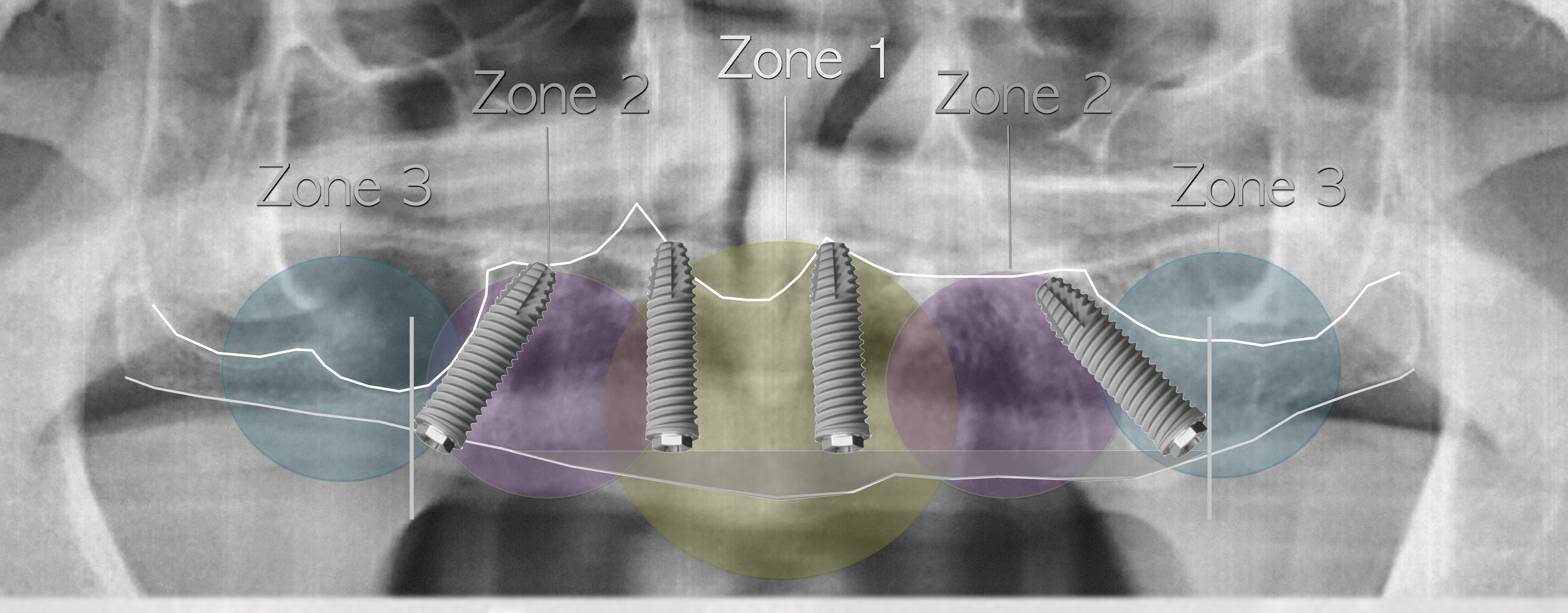 Ridge reduction affects implant length and AP spread