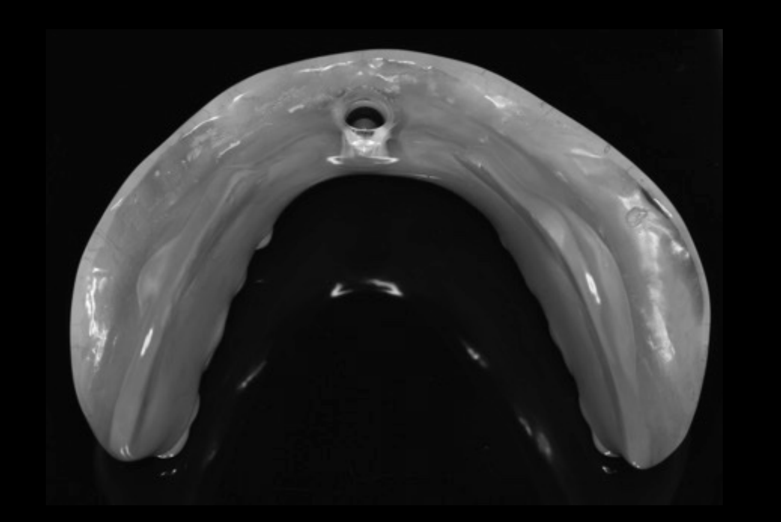 Implant Overdenture