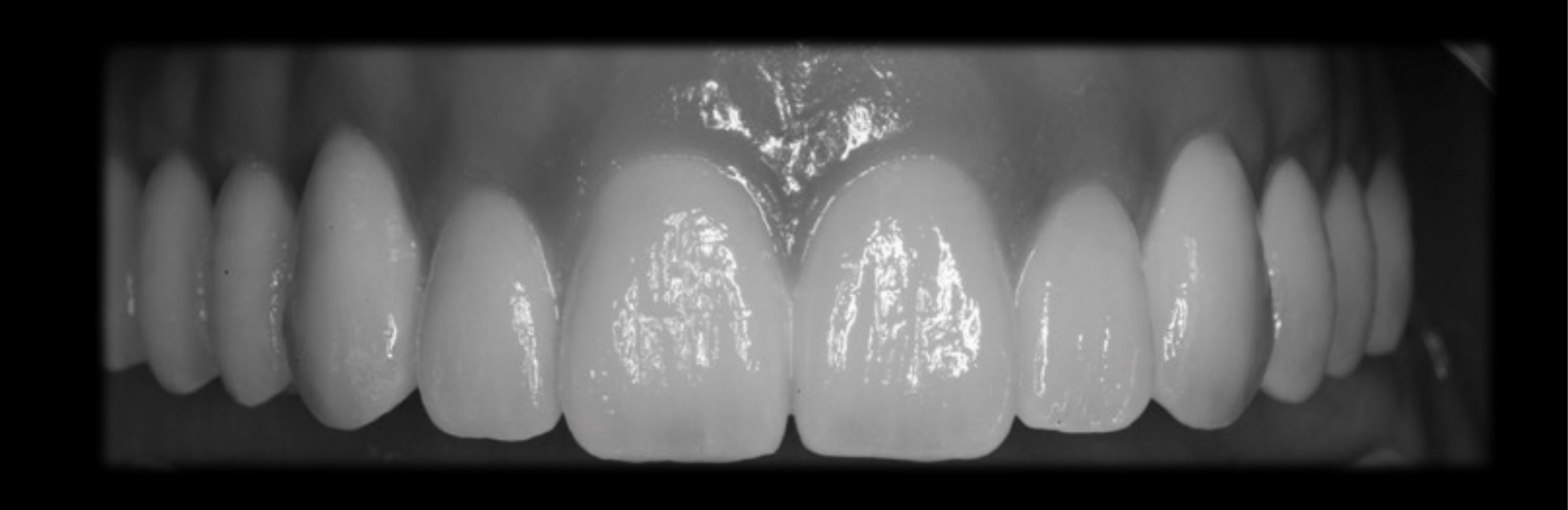 Need occlusal splint