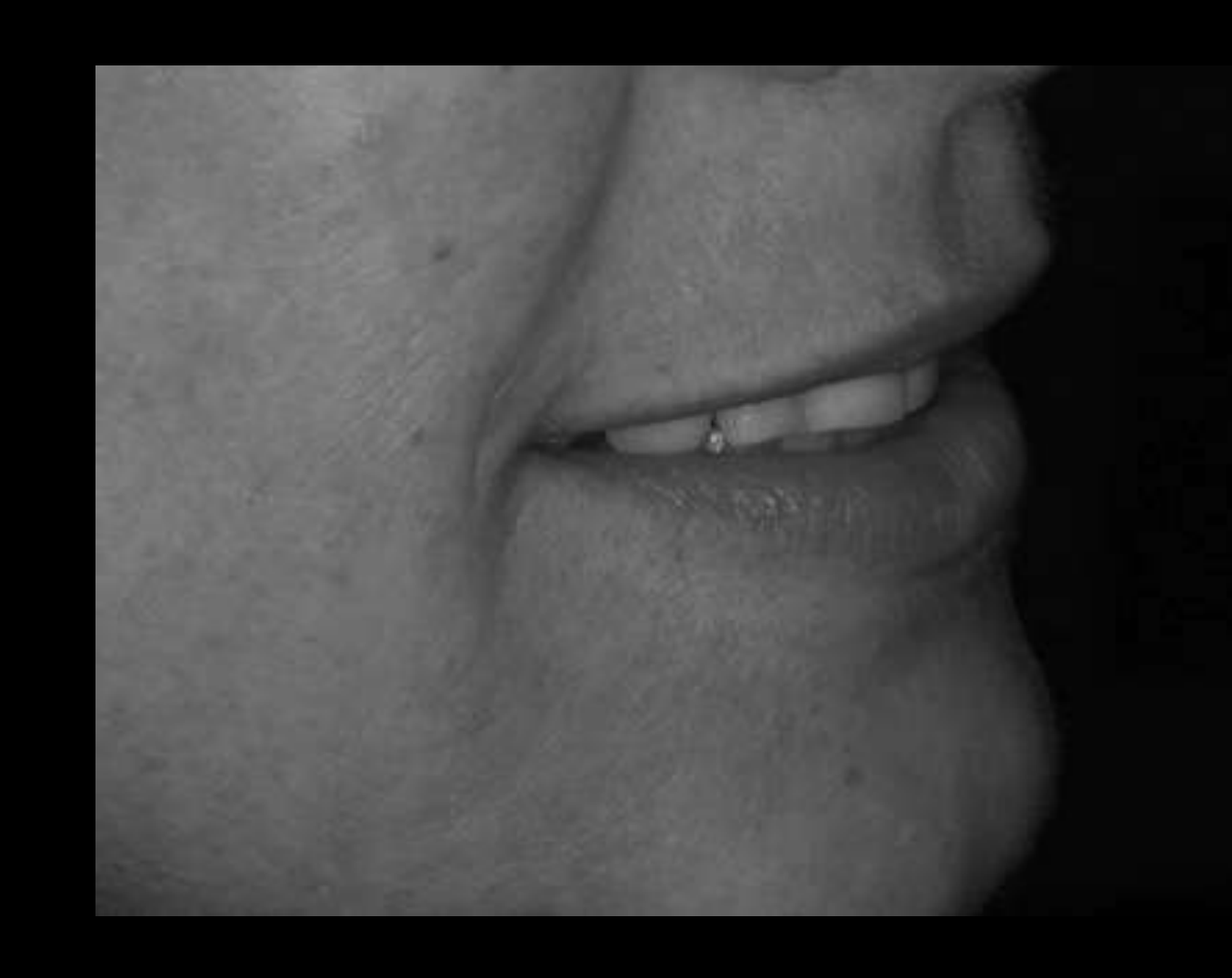 F, V Vermillion 1mm lingual