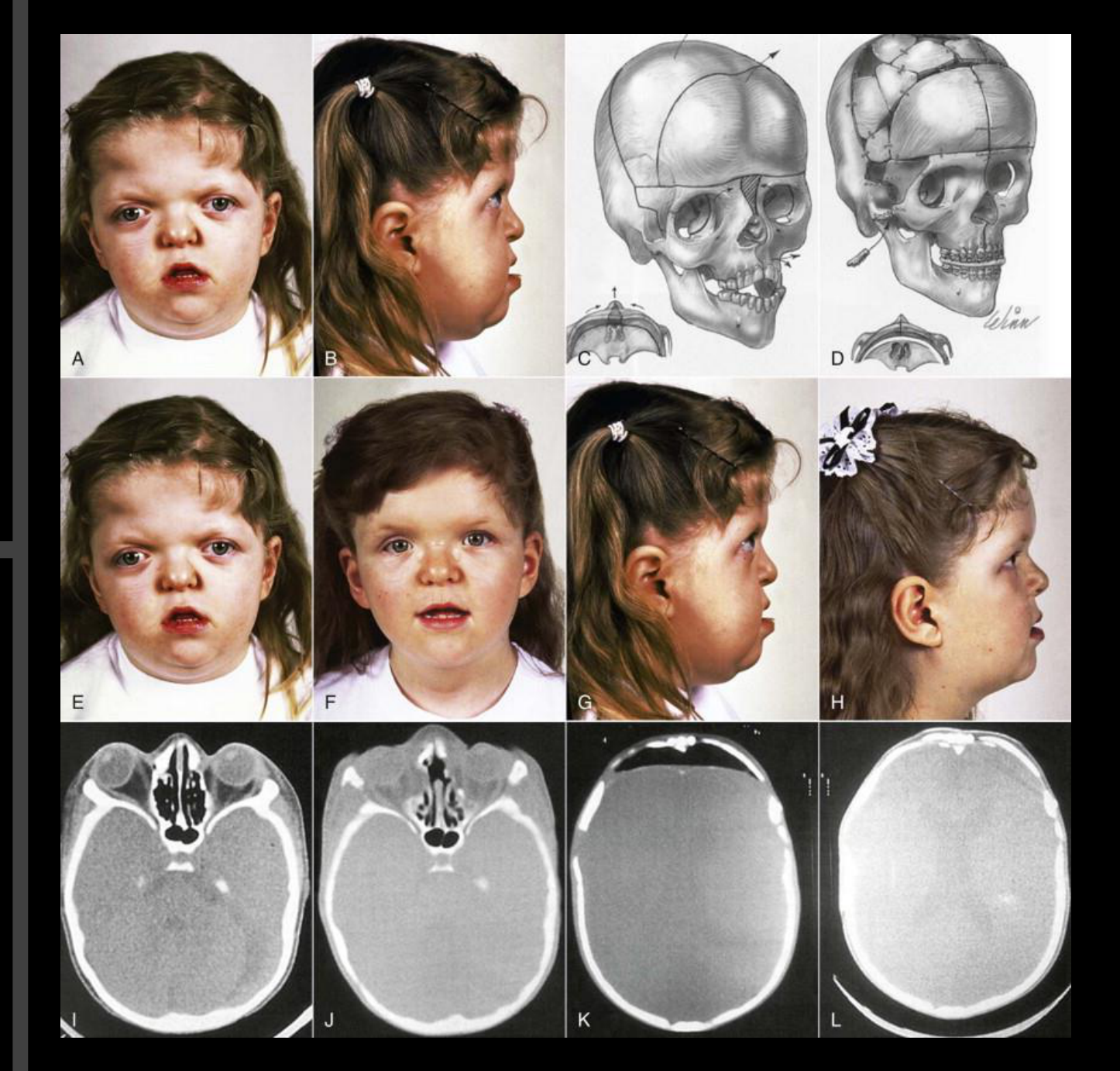 Apert Syndrome
