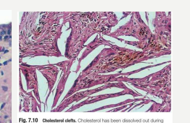Fig. 7.10 Cholesterol clefts. Cholesterol has been dissolved out during preparation of the section, leaving clefts. The crystals are treated as foreign bodies and flattened multinucleate foreign body giant cells are seen along the edges of several clefts.