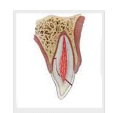 Crown-root fracture with pulp involvement