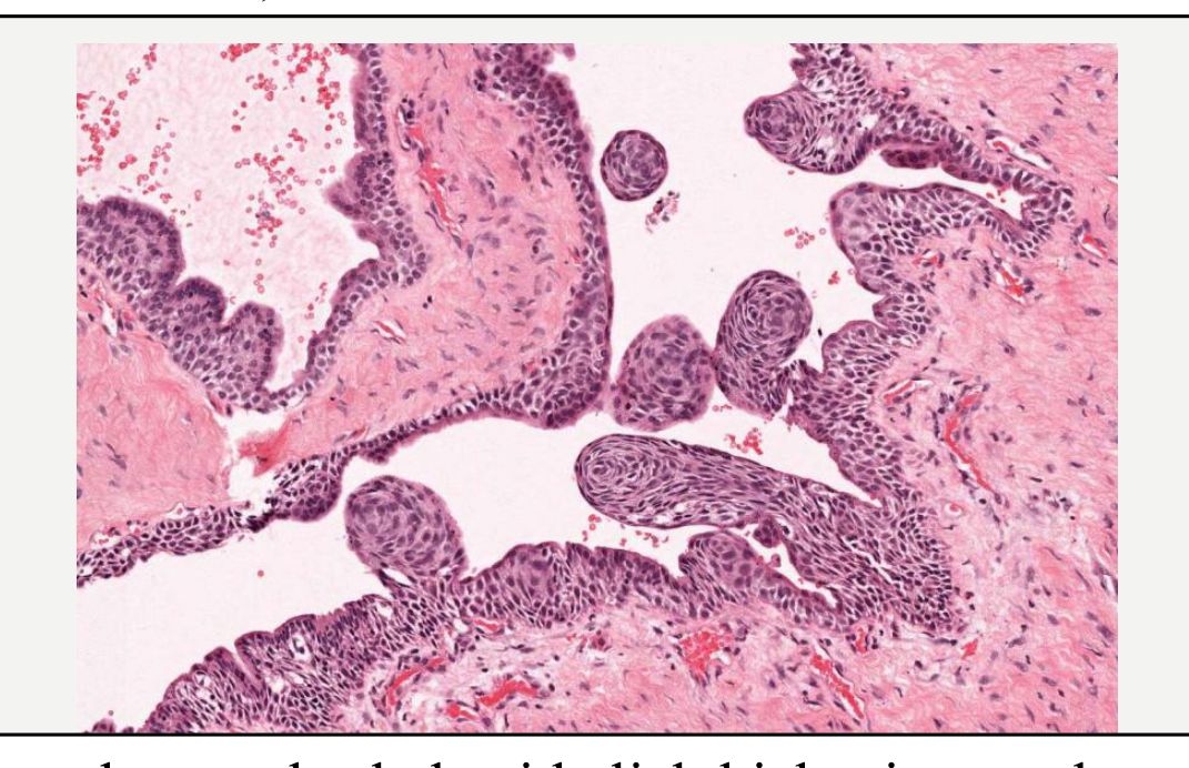 The lining shows whorled epithelial thickenings and papillary projections. Superficial columnar cells can also be seen. (WHO, 2022)