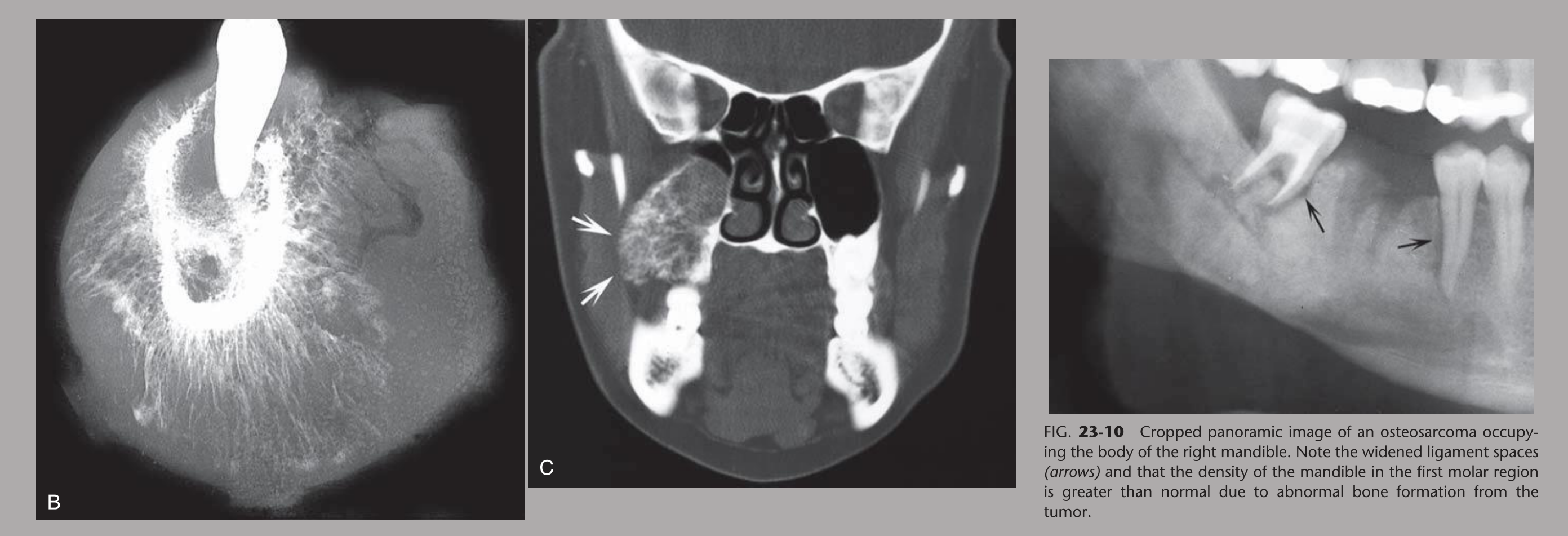 FIG. 23-10 Cropped panoramic image of an osteosarcoma occupying the body of the right mandible. Note the widened ligament spaces (arrows) and that the density of the mandible in the first molar region is greater than normal due to abnormal bone formation from the tumor.