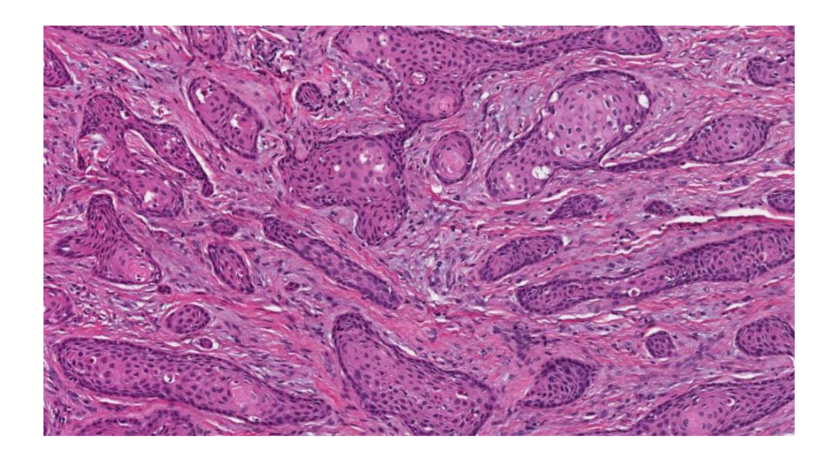 Islands of benign, squamous epithelium in a mature fibrous stroma. The peripheral cells are flattened, and central cells show areas of microcystic degeneration and individual cell keratinization. (WHO, 2022)