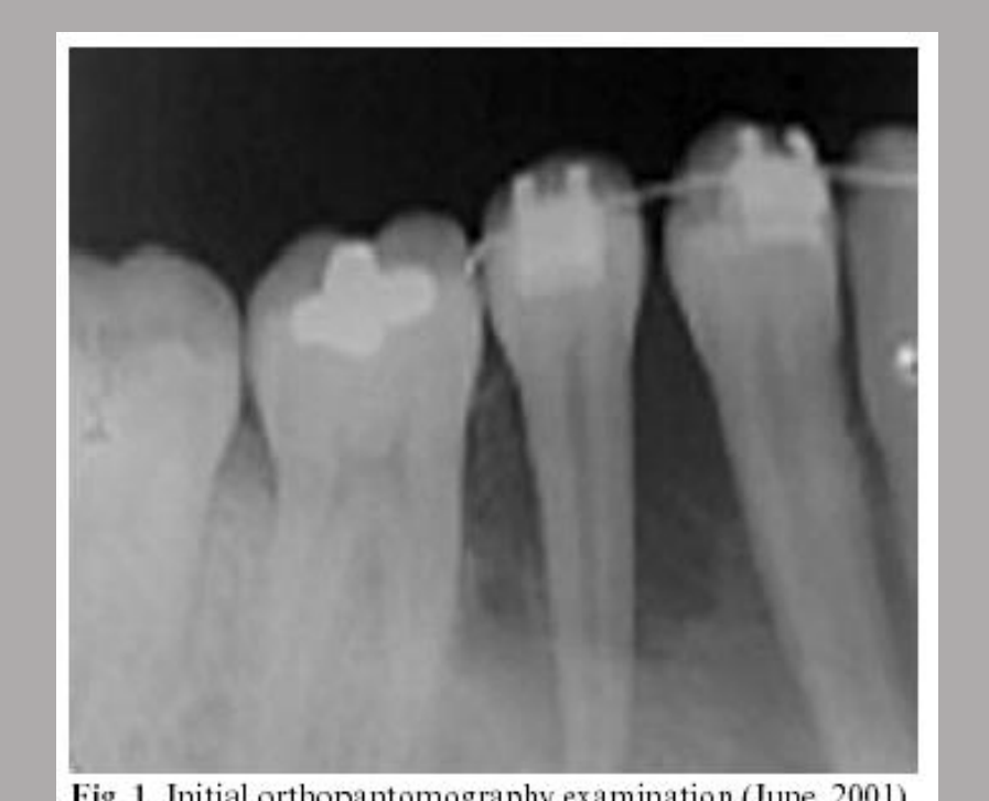 Fig. 1. Initial orthopantomography examination (June, 2001). The radiograph displayed a mild radiolucent lesion involving the right madibular second premolar.