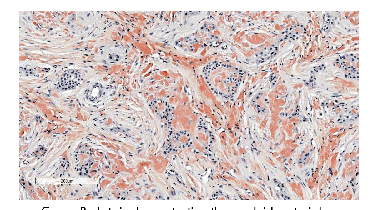 Congo Red stain demonstrating the amyloid material. (WHO, 2022)