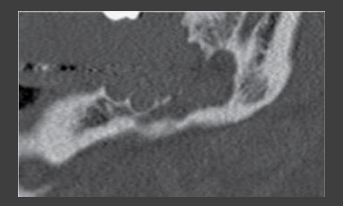 FIG. 23-6 The multilocular radiolucency in this radiograph is characteristic of central mucoepidermoid carcinoma; this lesion has displaced the mandibular canal and destroyed the superior crest of the alveolar process and the distal supporting bone of the second molar.
