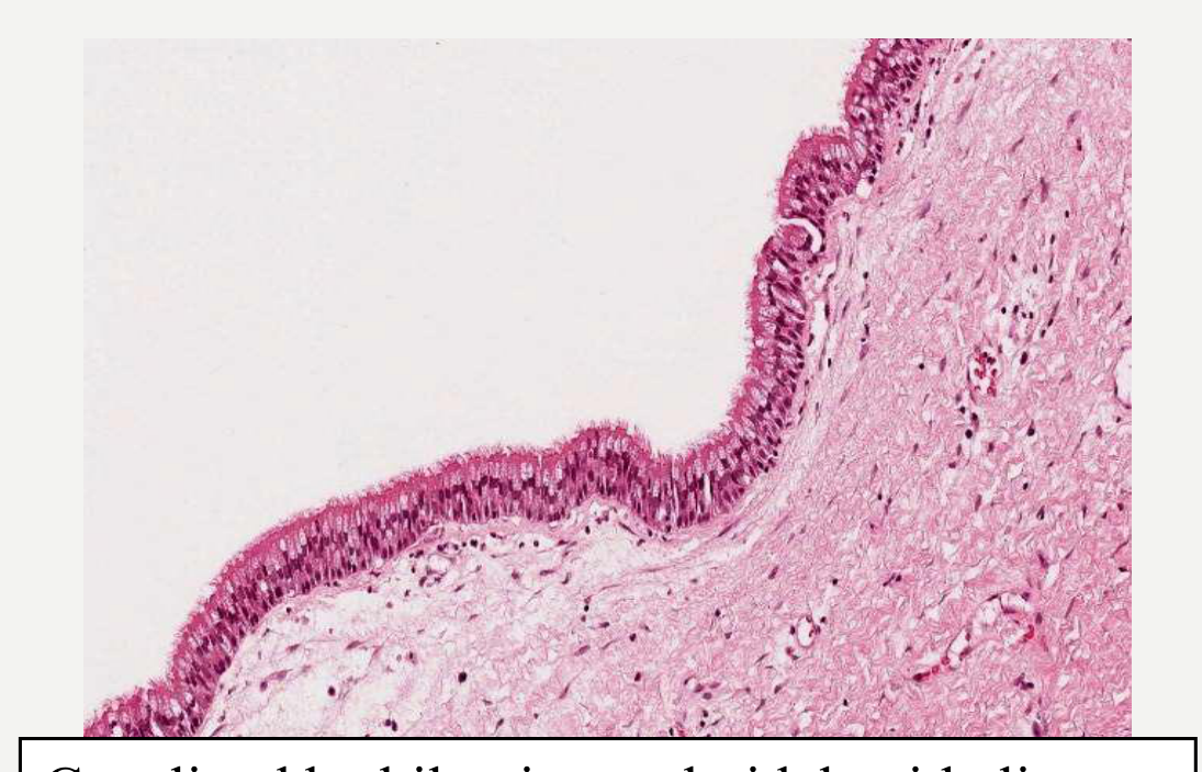 Cyst lined by bilaminar cuboidal epithelium with focal cilia. (WHO, 2022)
