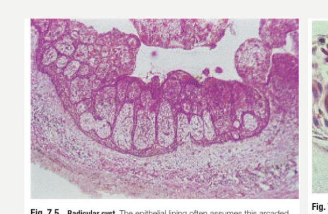Fig. 7.5 Radicular cyst. The epithelial lining often assumes this arcaded pattern with numerous inflammatory cells beneath its surface.
