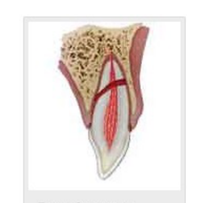 Root fracture