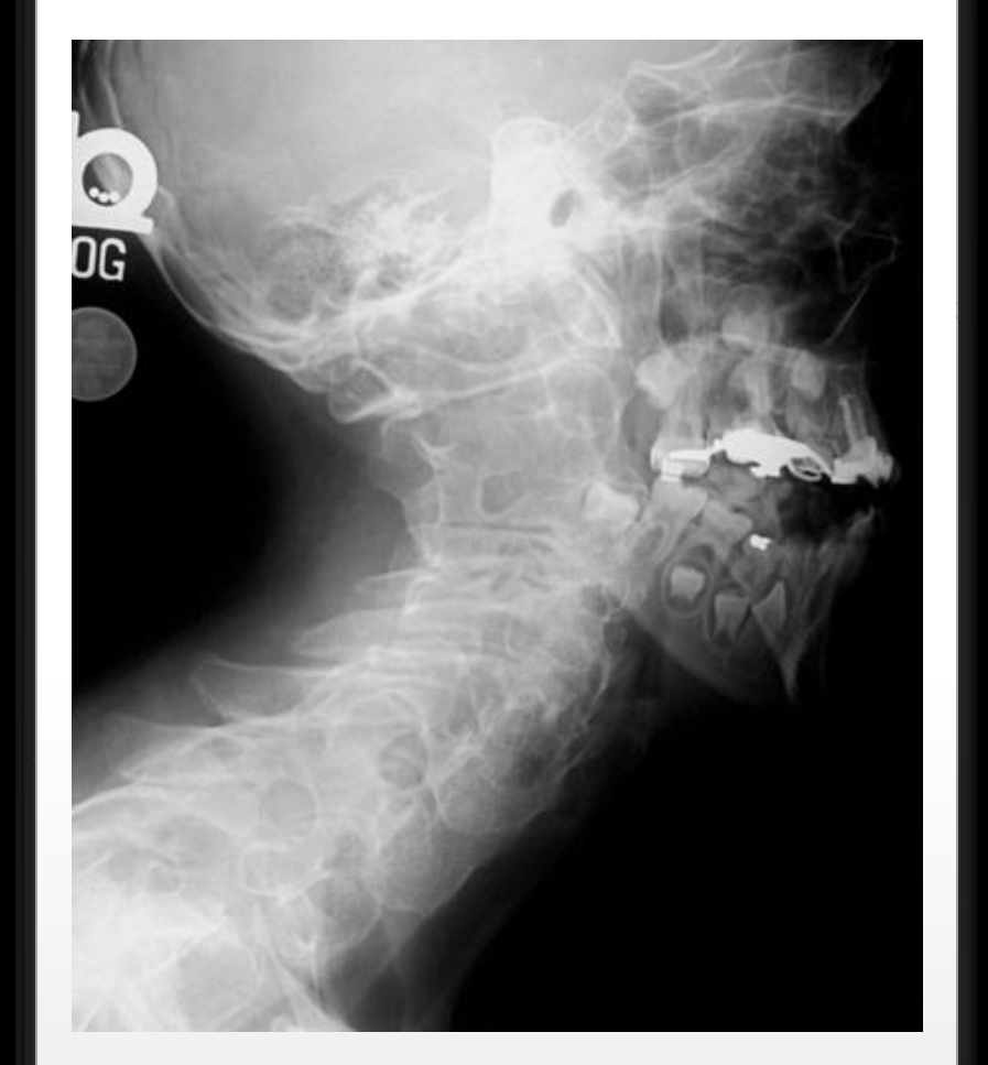 Proteus syndrome