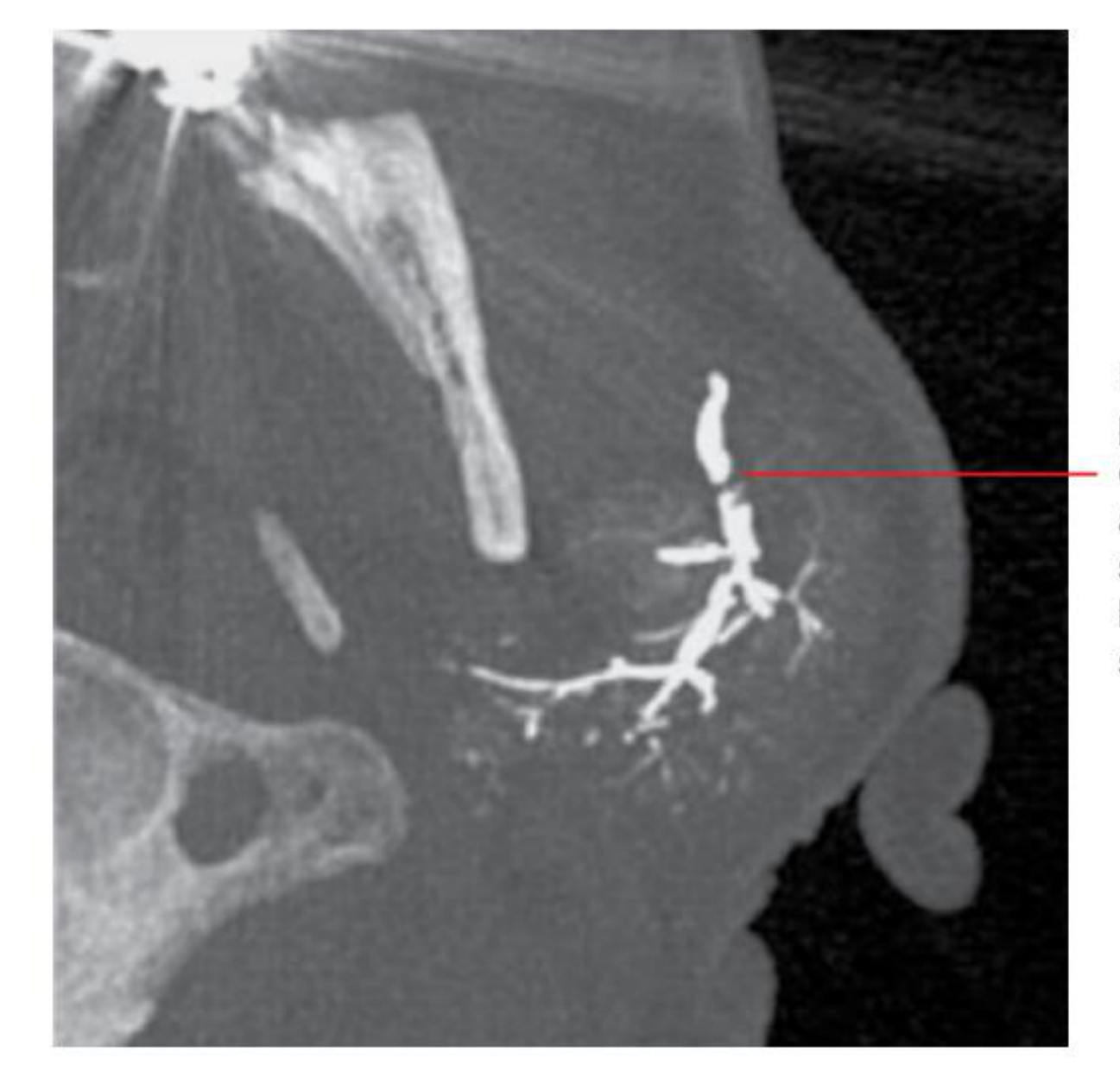 Figure 16.24 Mucus plug/non-calcified ductal sialolith related to the left parotid gland (recurrent swelling related to meals): axial maximum intensity projection MDCT sialogram image.