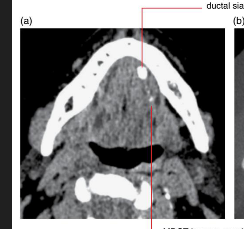 MDCT is more sensitive than CBCT at detecting small sialoliths. The MDCT (soft tissue window) image demonstrates the small ductal sialoliths proximal to the large distal sialolith. These small sialoliths are not demonstrated in the CBCT image
