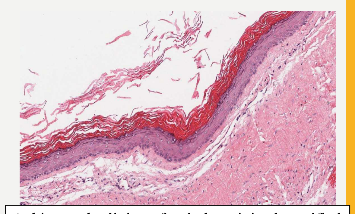A thin regular lining of orthokeratinized stratified squamous epithelium. The keratin is lamellated and extends into the lumen (WHO, 2022)