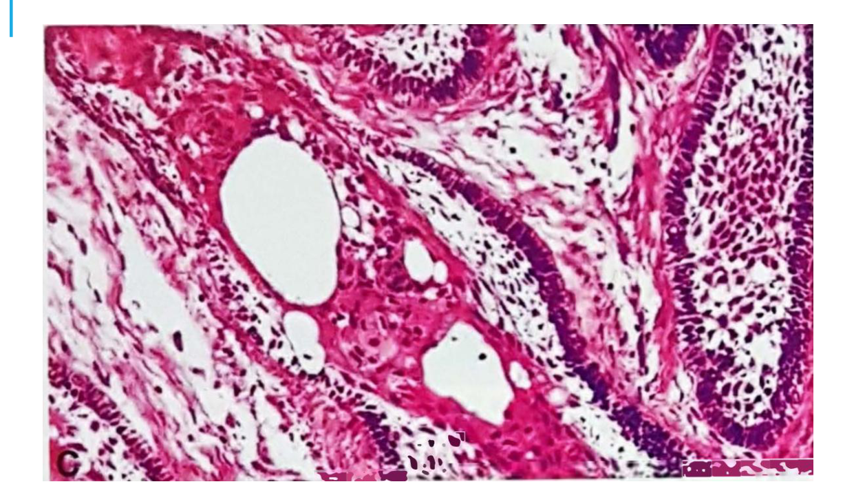 Acanthomatous type