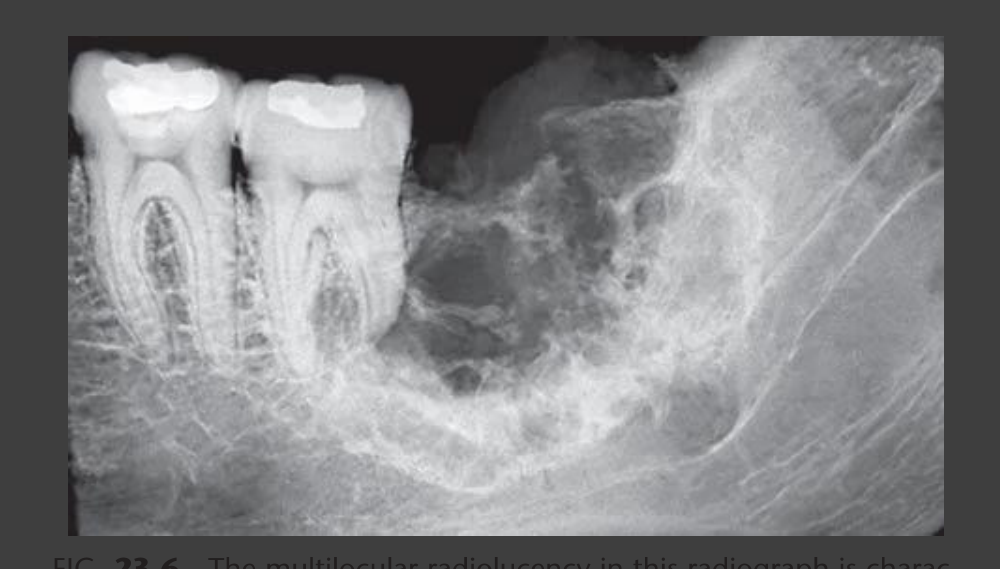 FIG. 23-6 The multilocular radiolucency in this radiograph is characteristic of central mucoepidermoid carcinoma; this lesion has displaced the mandibular canal and destroyed the superior crest of the alveolar process and the distal supporting bone of the second molar.