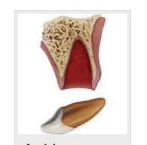 Avulsion