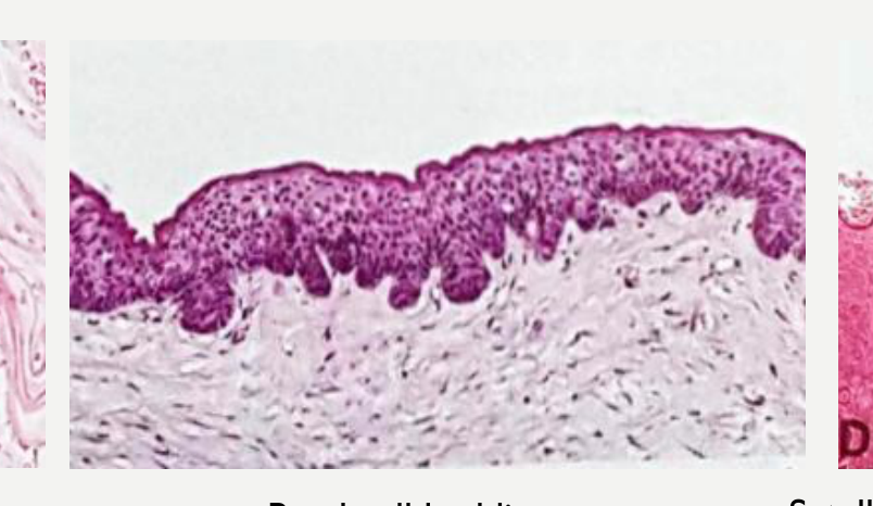 Basal cell budding