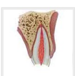 Enamel-dentin-pulp fracture