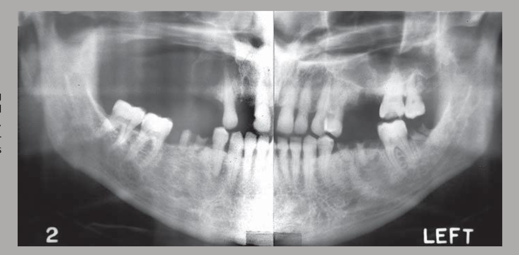 FIG. 23-13 A fibrosarcoma involving the right maxillary sinus has destroyed the cortical boundaries of the sinus, zygomatic process, hard palate and posterior maxilla, and the alveolar process in this panoramic film.