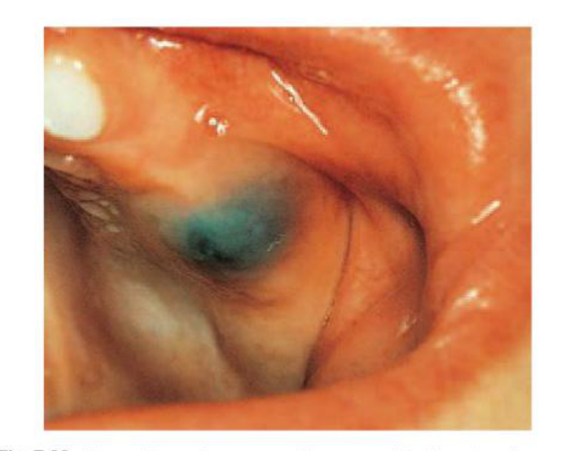 Fig. 7.23 An eruption cyst over an erupting upper molar. There has been bleeding into the cyst cavity as a result of trauma.