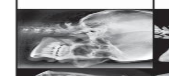 Lateral Ceph