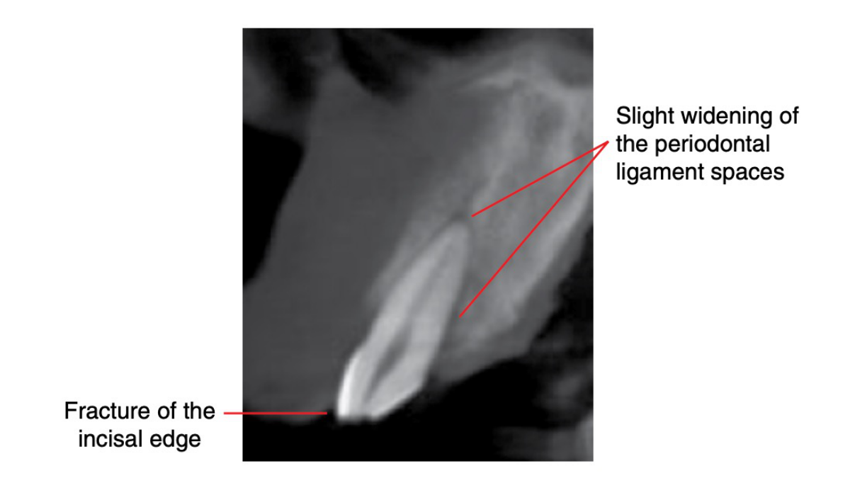 Figure 17.6 Acute traumatic crown fracture with subluxation, 13: corrected sagittal CBCT image.
