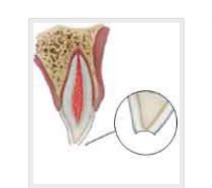 Enamel fracture
