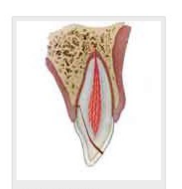 Crown-root fracture without pulp involvement