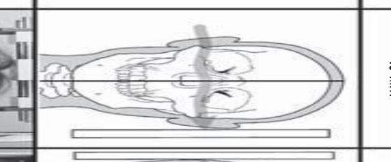 Oblique Lateral Body