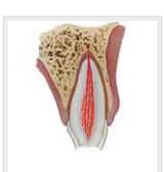 Enamel-dentin fracture