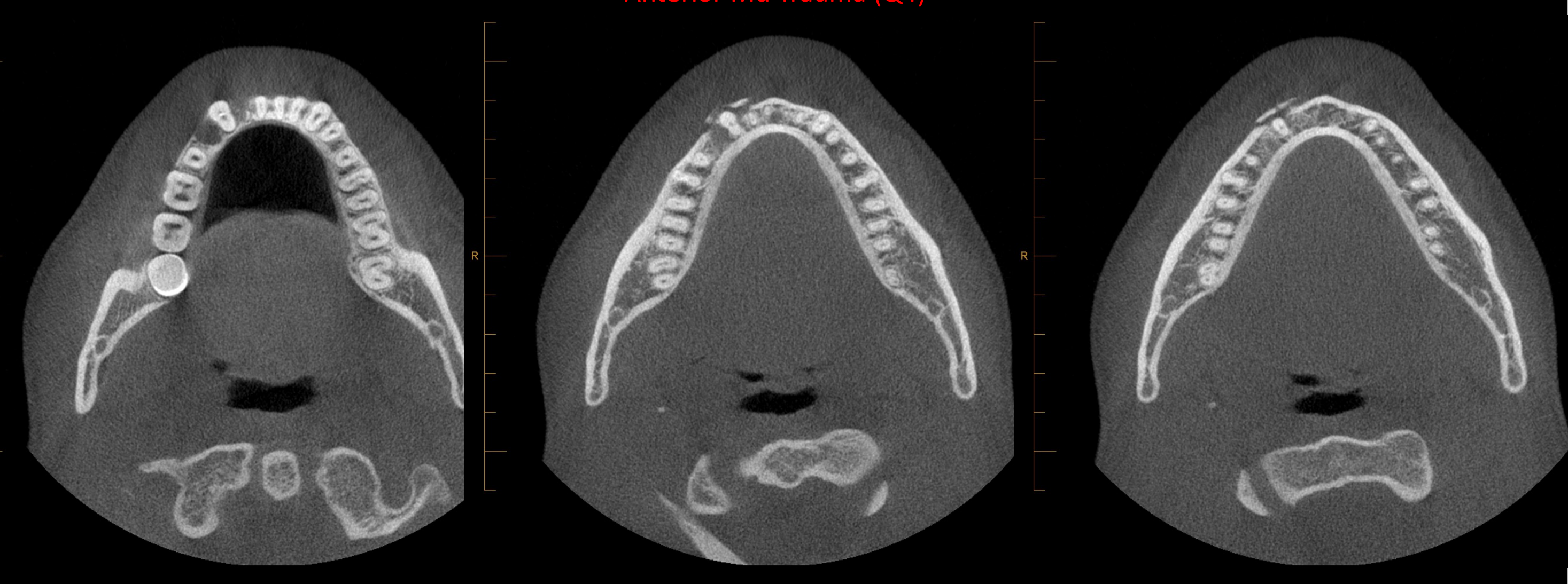Anterior Md Trauma (Q4)