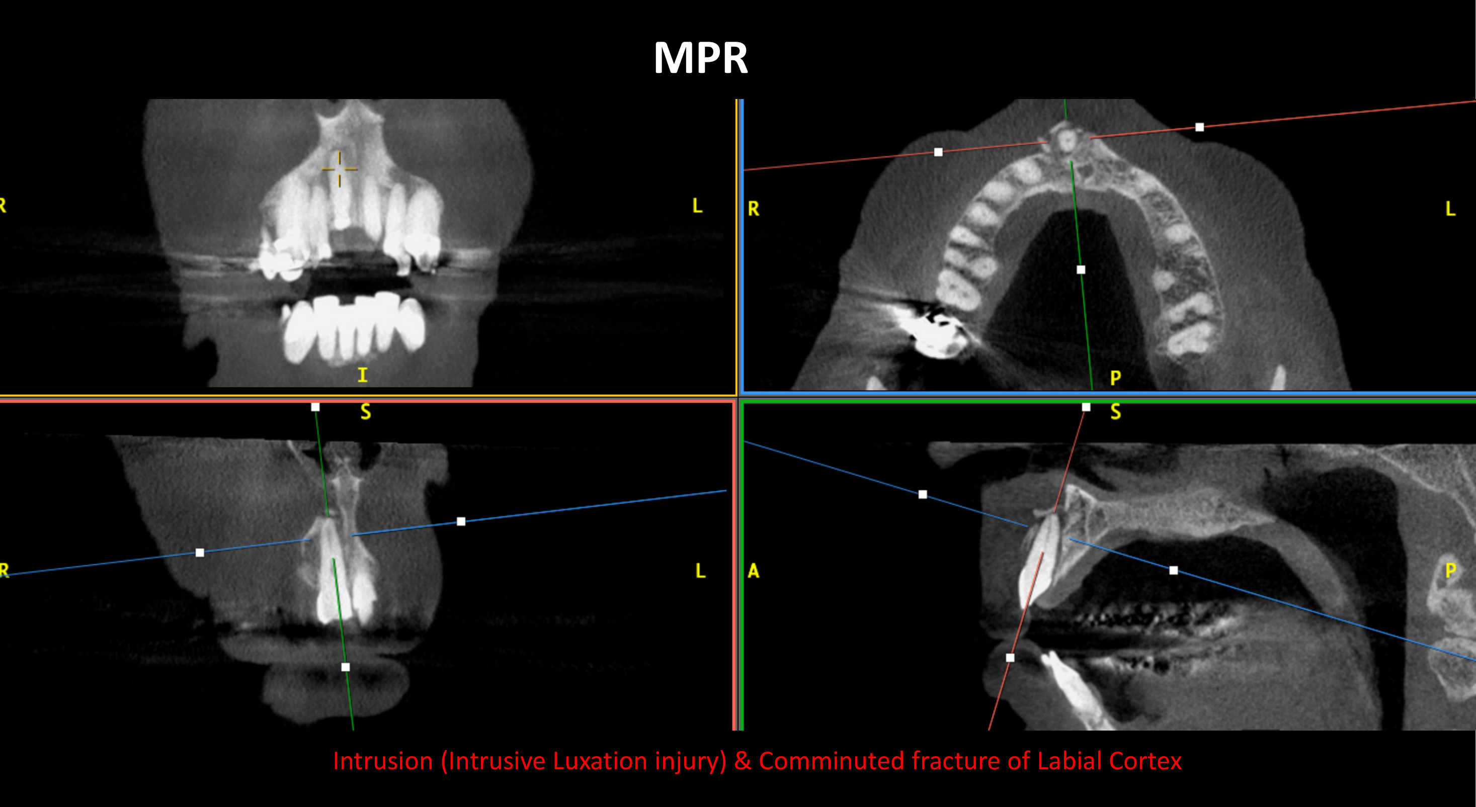 Intrusion (Intrusive Luxation injury) & Comminuted fracture of Labial Cortex