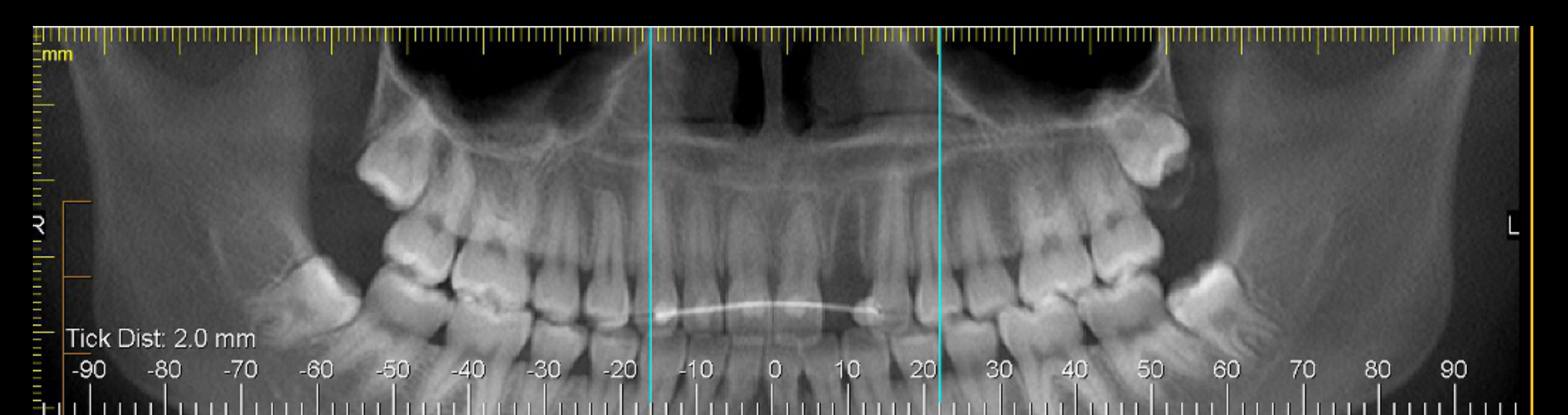 Anterior Mx Trauma (22 site)